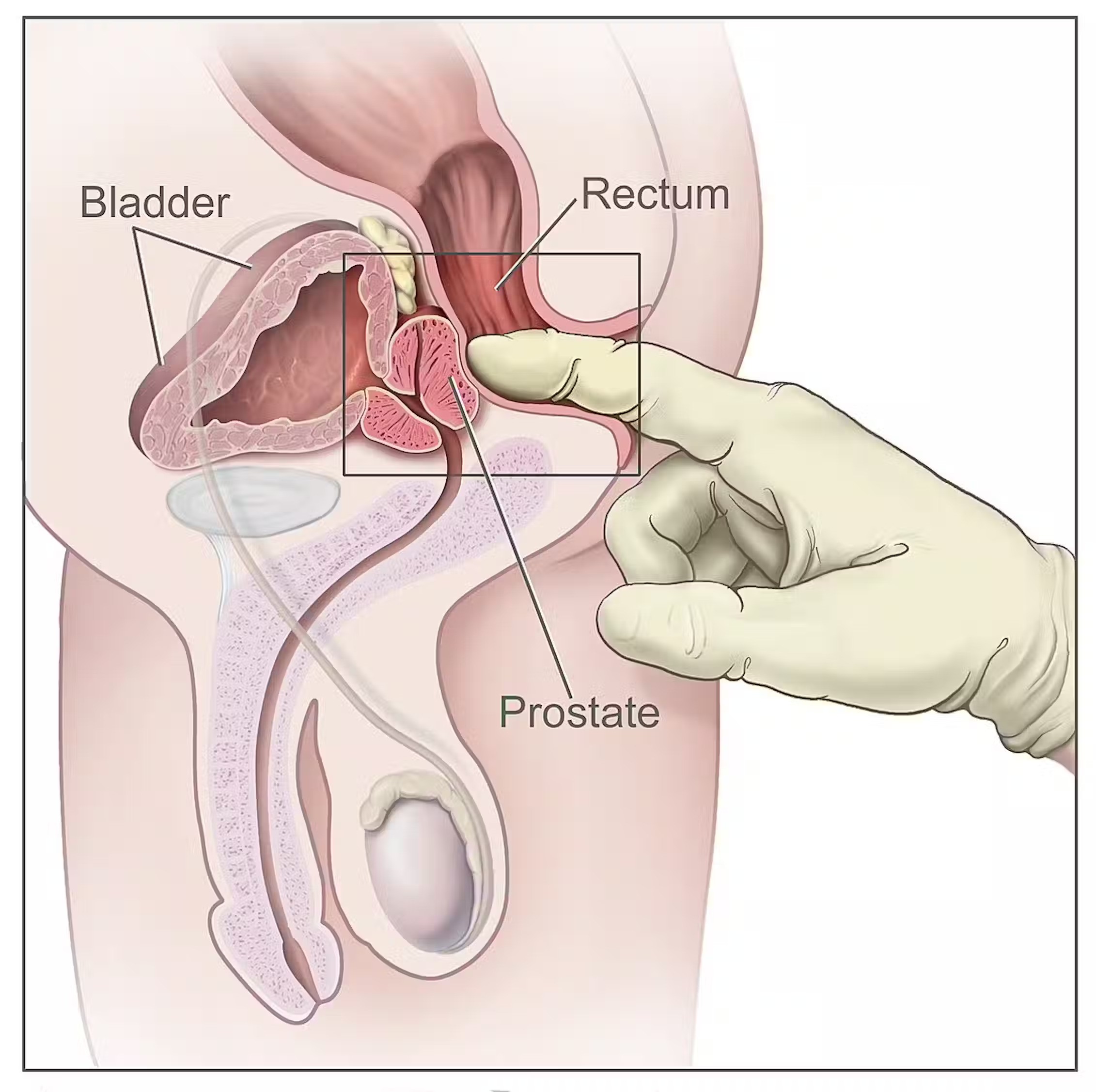 Anal Cancer Diagnosis Image