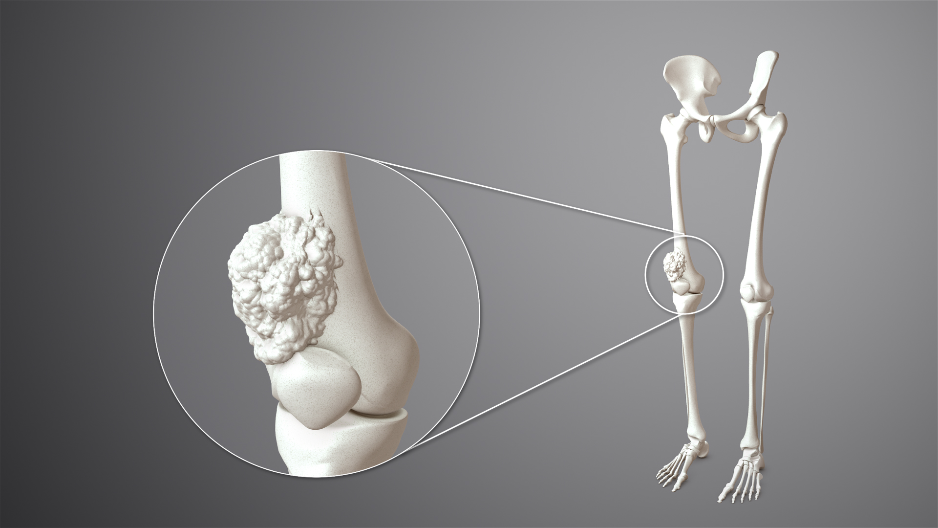 Types of Soft Tissue Sarcoma Cancer​