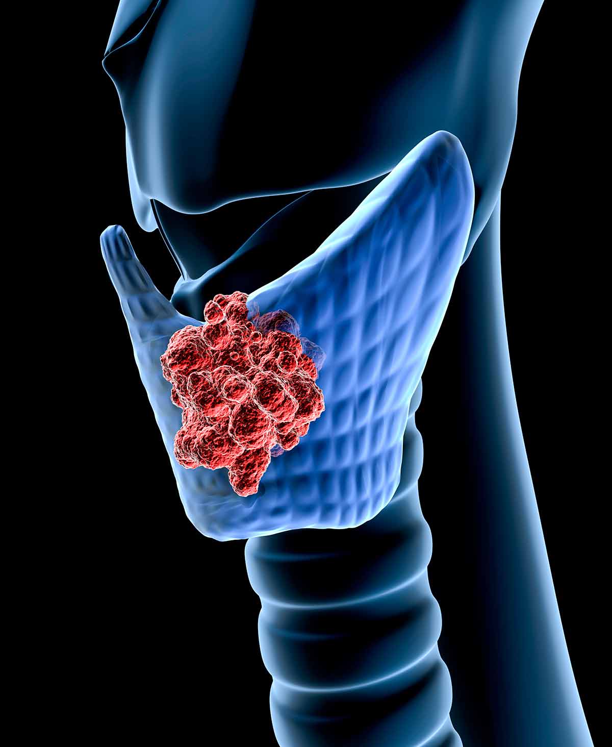 Types Of Thyroid Cancer​