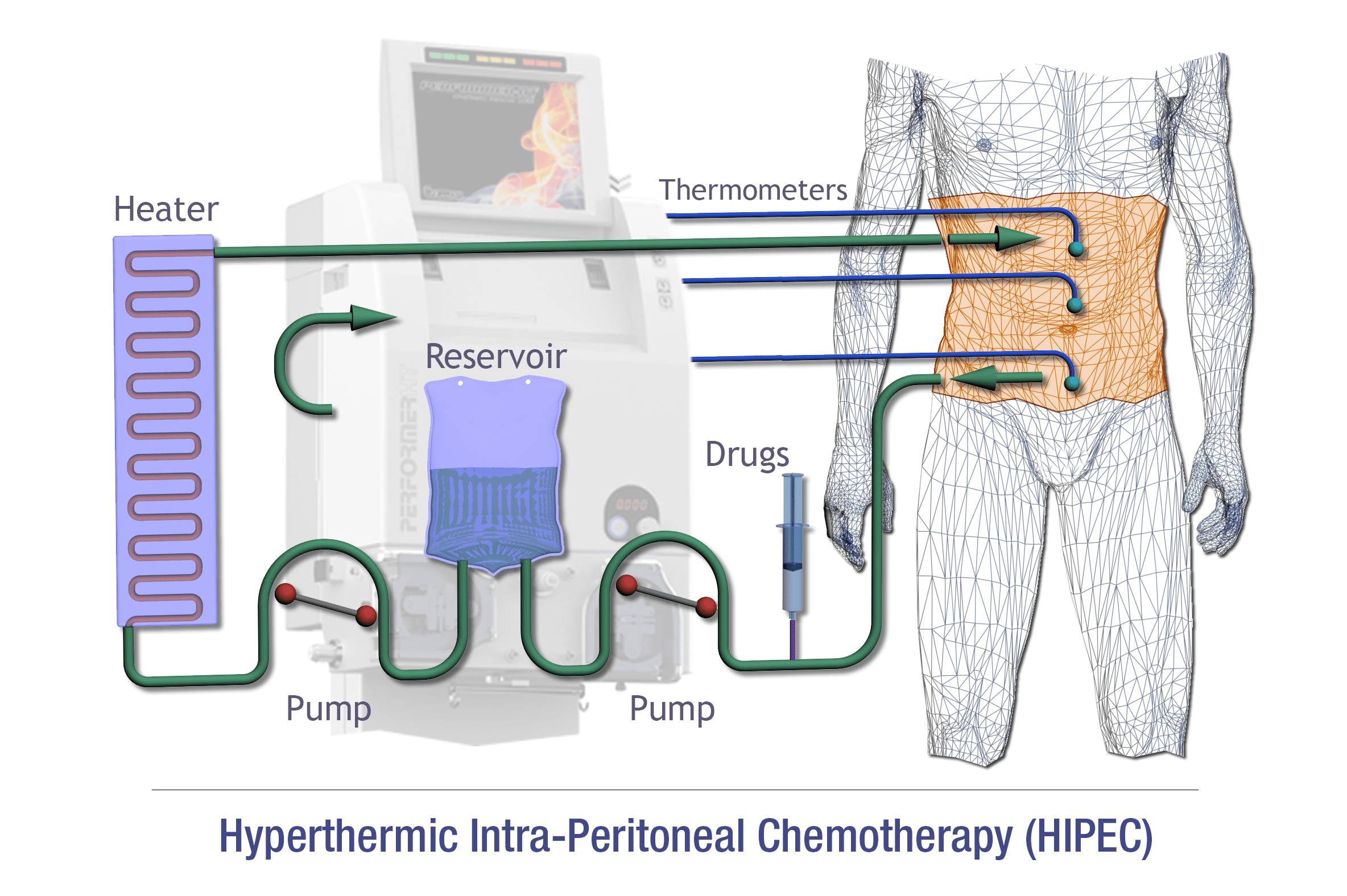Benefits of Early Detection Of Peritoneal Cancer​