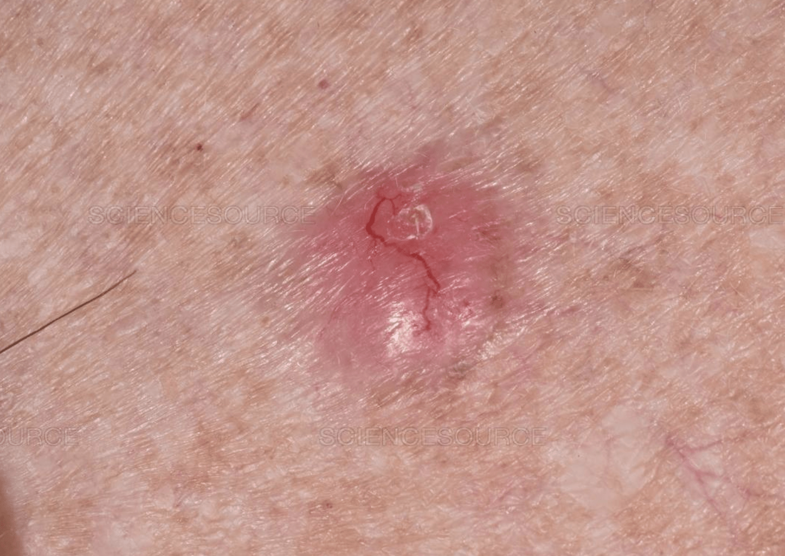 Skin Cancer Symptoms
