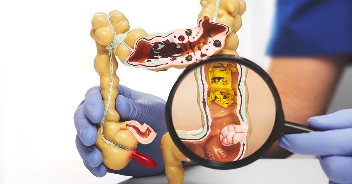Colorectal Cancer Diagnosis Image