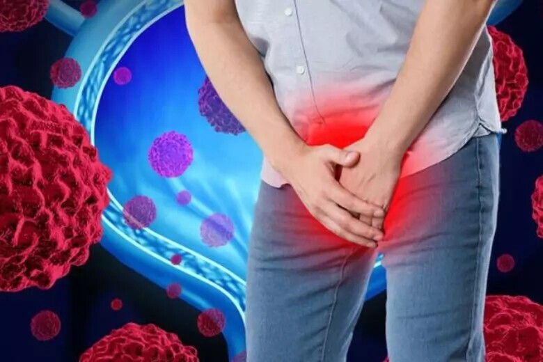 Bladder Cancer Diagnosis Image