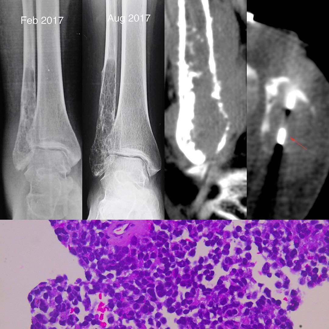 Signs and Symptoms of Soft Tissue Sarcoma Cancer​