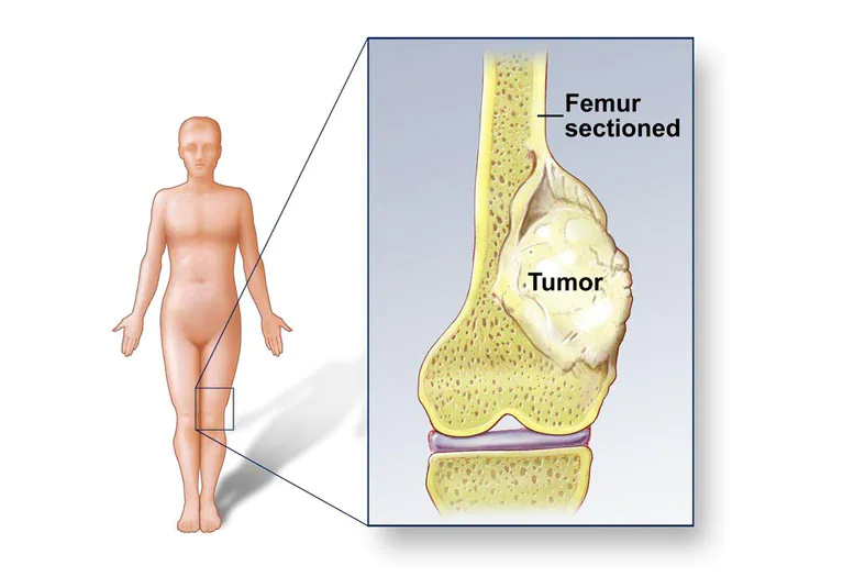 Soft Tissue Sarcoma Cancer Diagnosis​