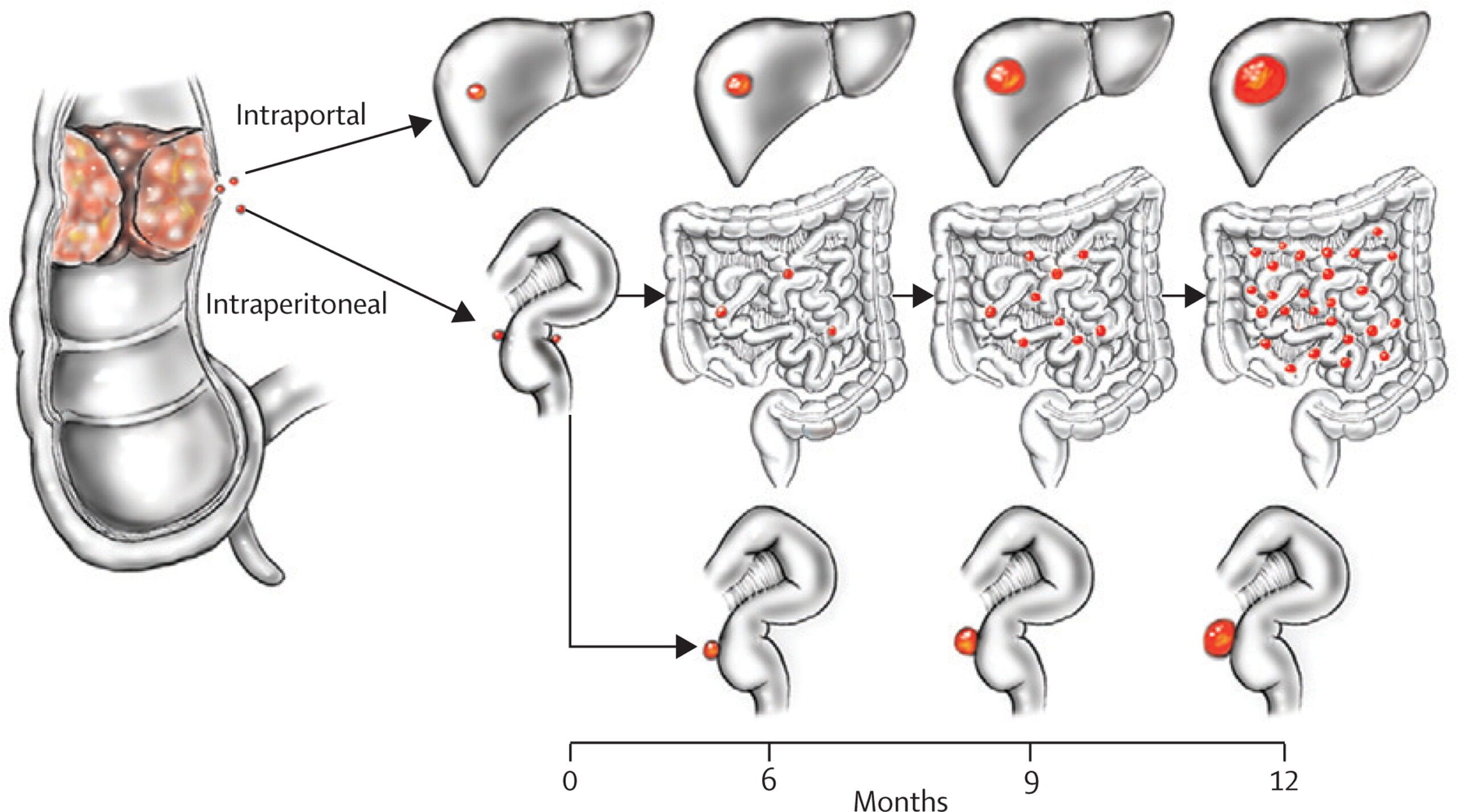 Peritoneal Cancer Treatment Options​