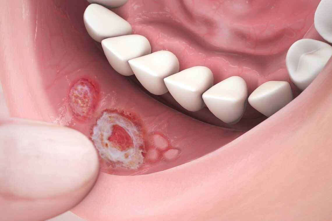 causes of canker sores