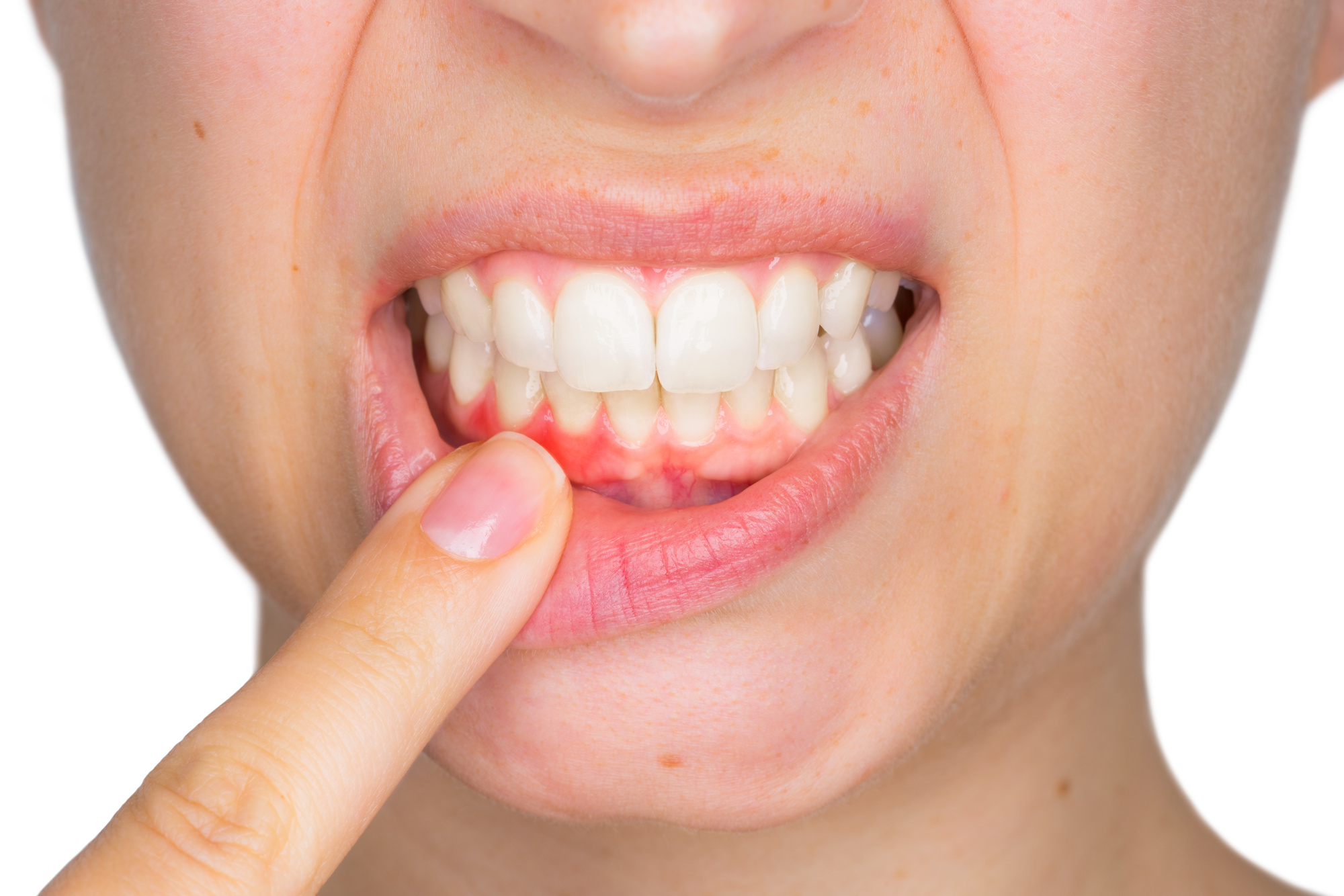 Canker Sores Vs Oral Cancer