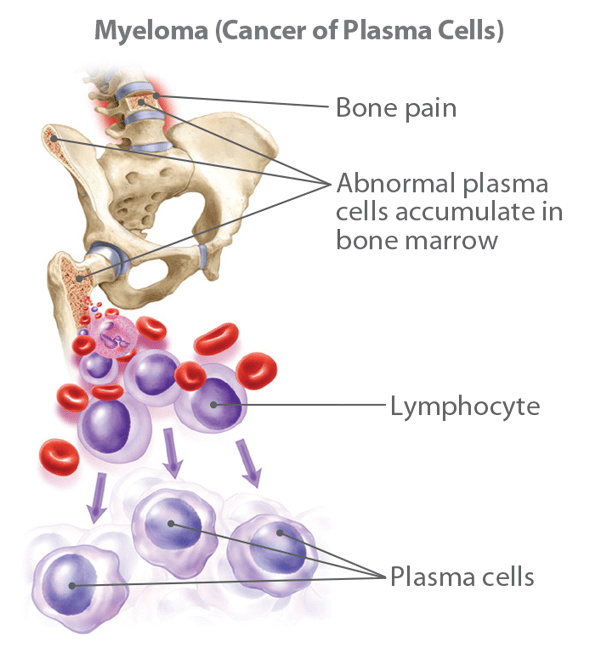 Causes and Risk Factors of Prostate Cancer​