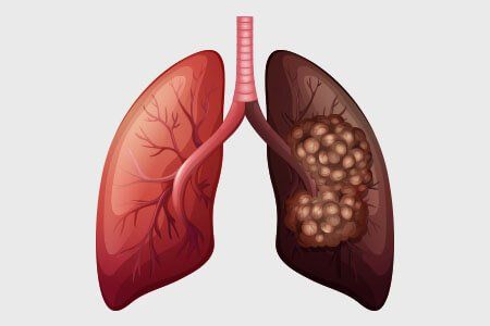 Lung Cancer Diagnosis Image