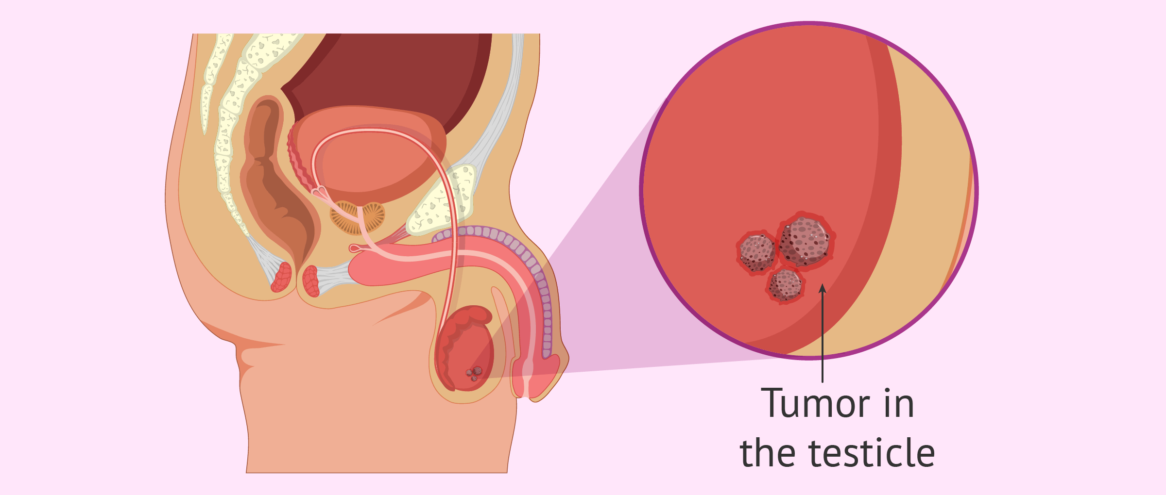 Testicular Cancer Treatment Options​