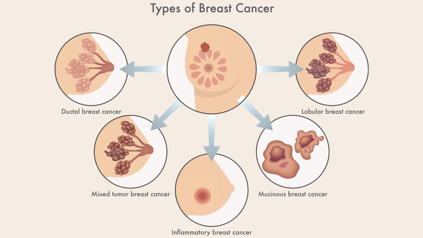 Breast Cancer Types Image
