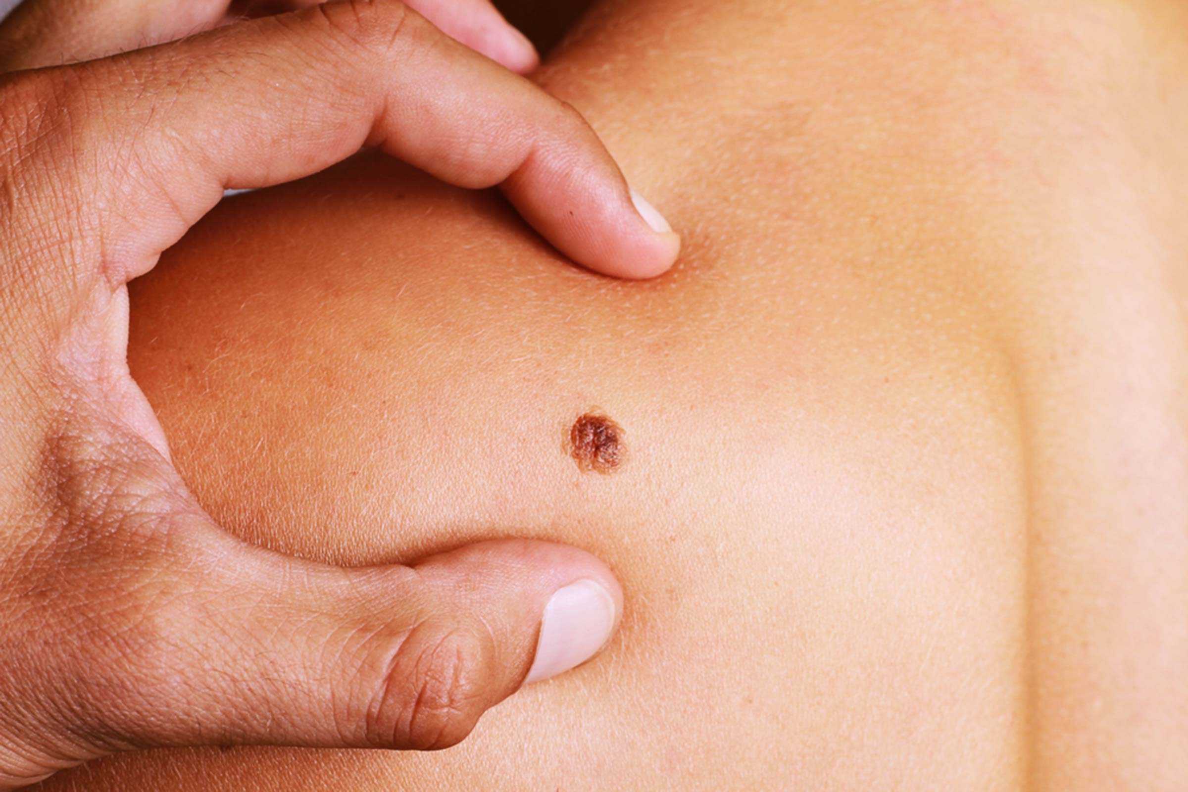 Skin Cancer Treatment Options​