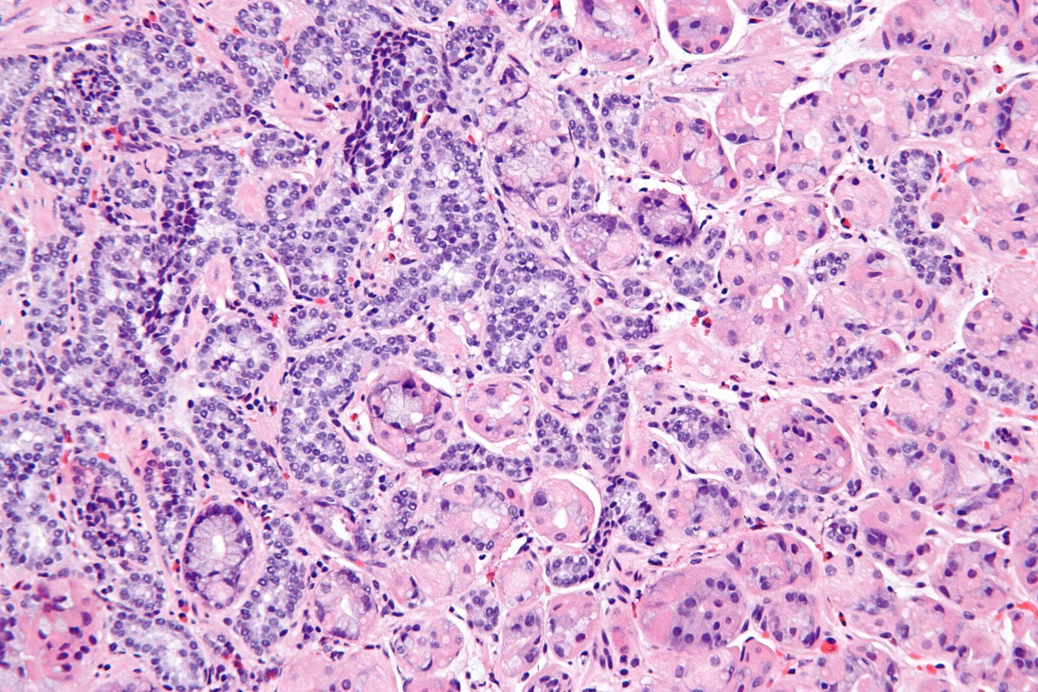 How Neuroendocrine Tumor Cancer Develops​