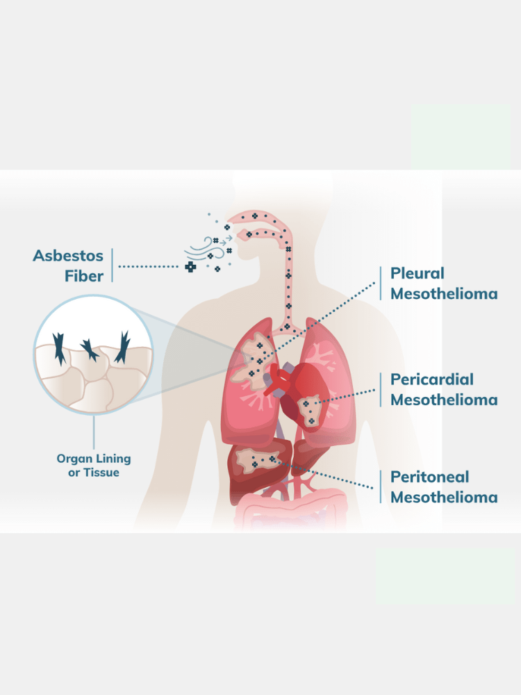 Mesothelioma Cancer Treatments Image