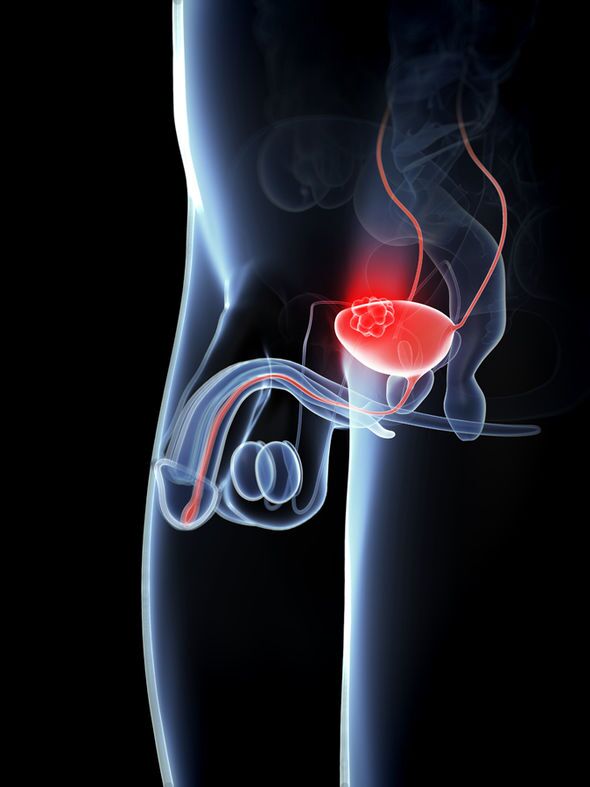 Signs & Symptoms Testicular Cancer​