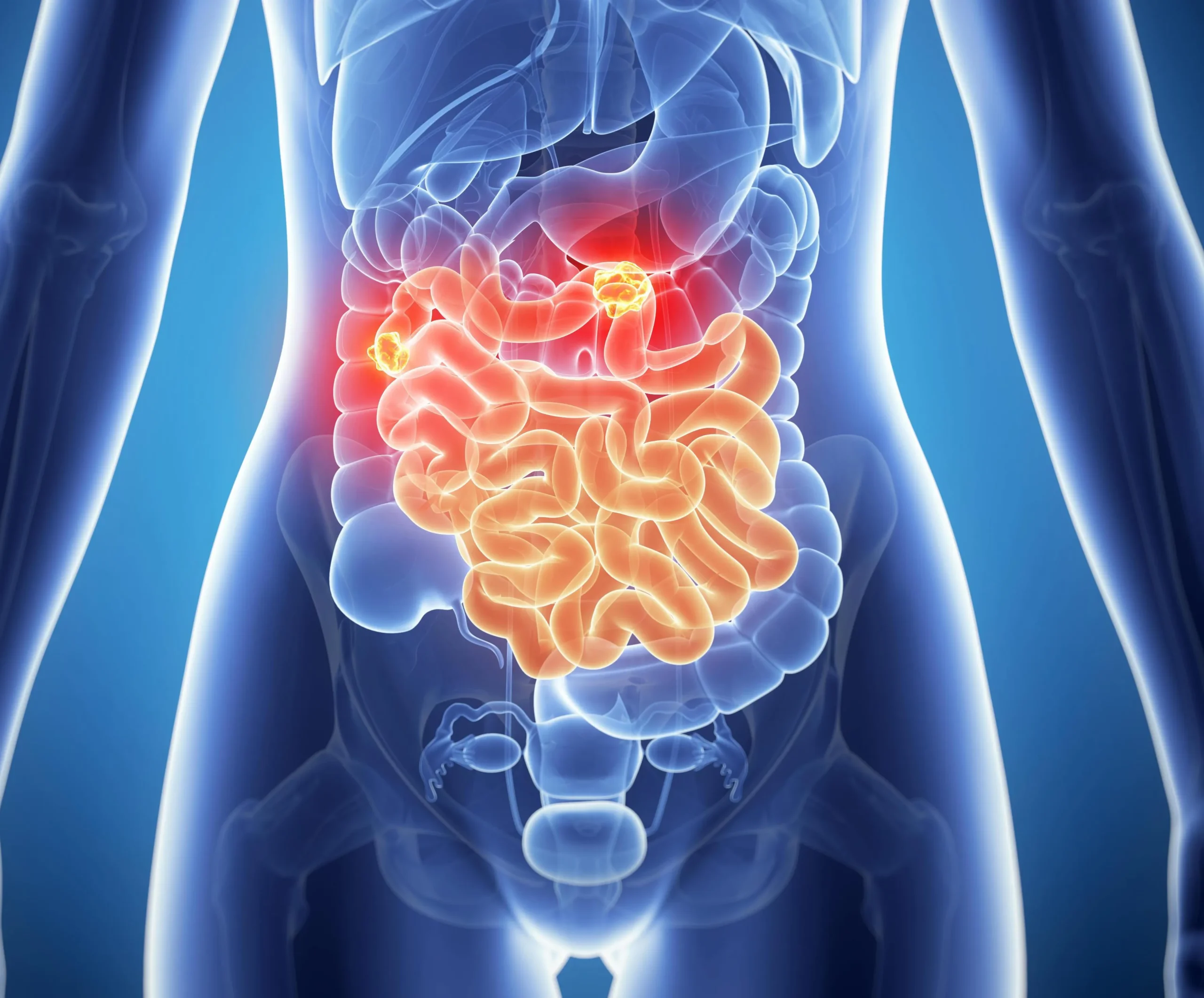 Neuroendocrine Tumor Diagnosis​