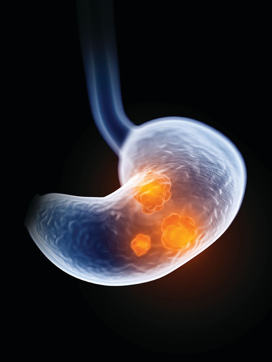 Treatment Of Stomach Cancer​