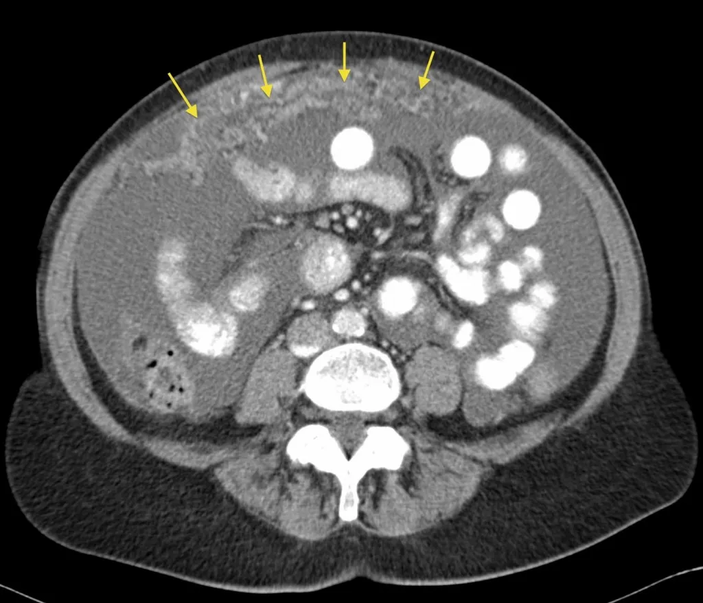 Risk Factors Peritoneal Cancer​