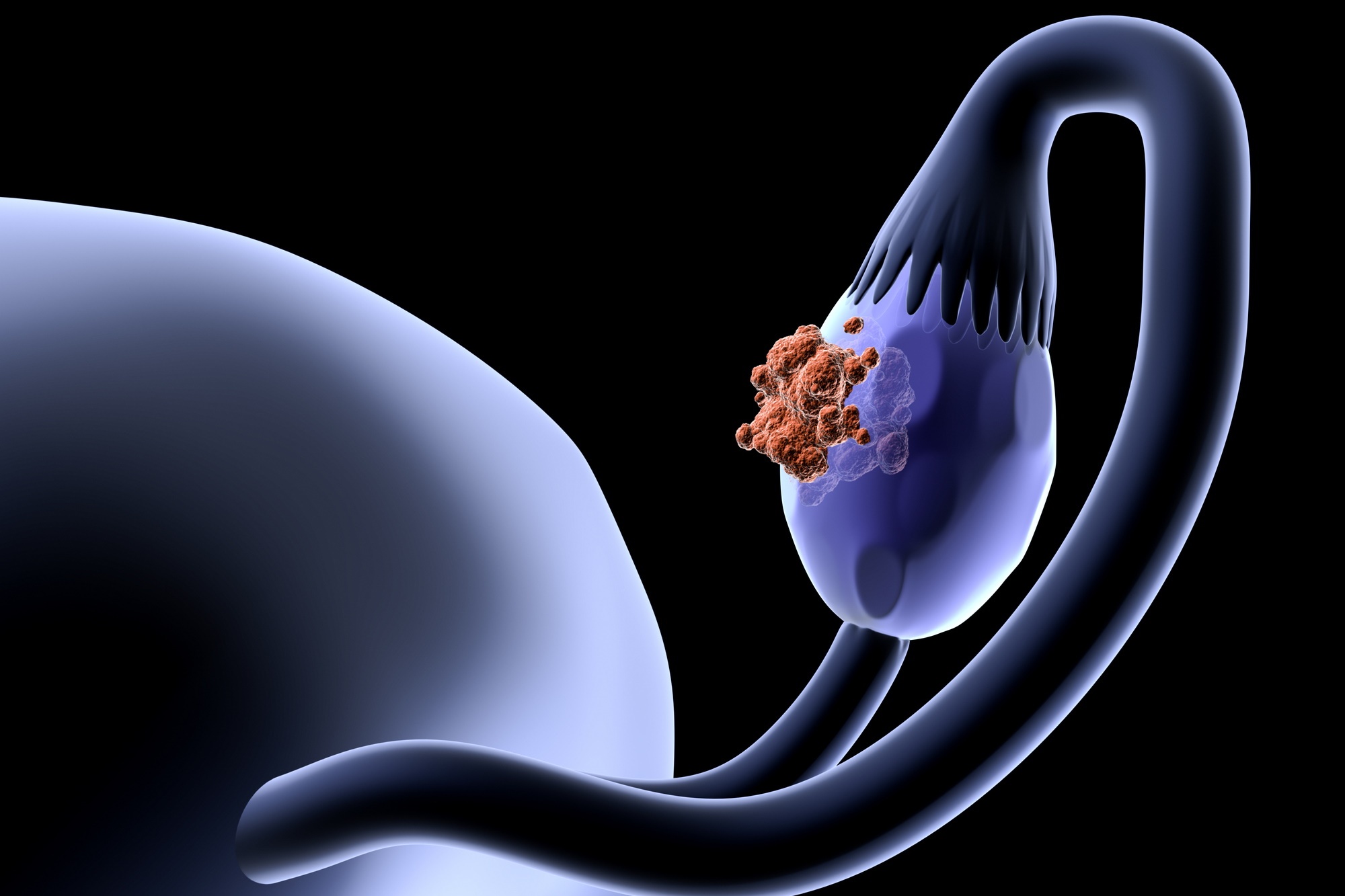 Signs of Ovarian Cancer​