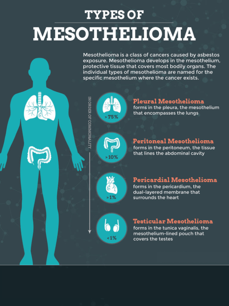 Mesothelioma Cancer Diagnosis Image