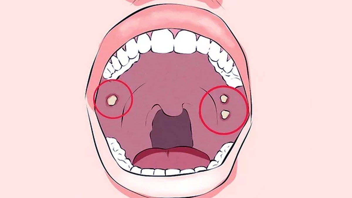 Diagnosis of Oral Cancer​
