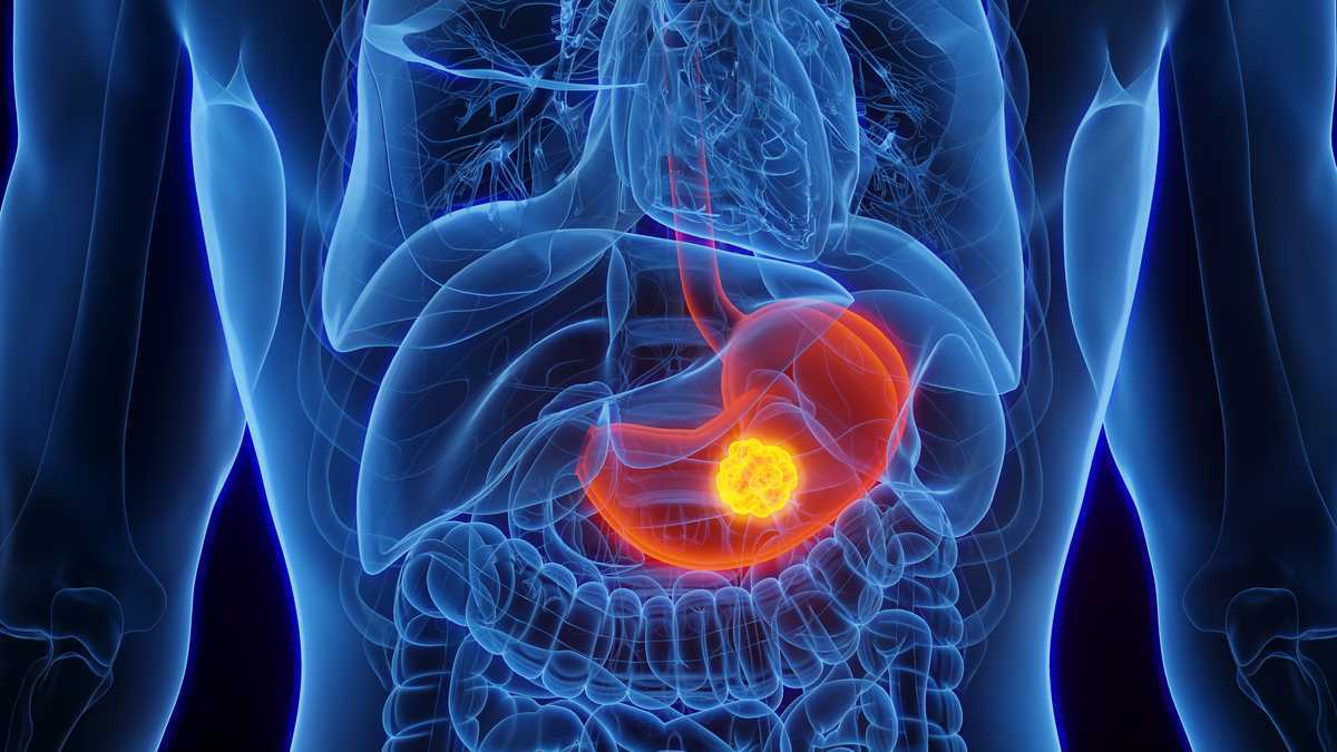 Stomach Cancer Diagnosis​