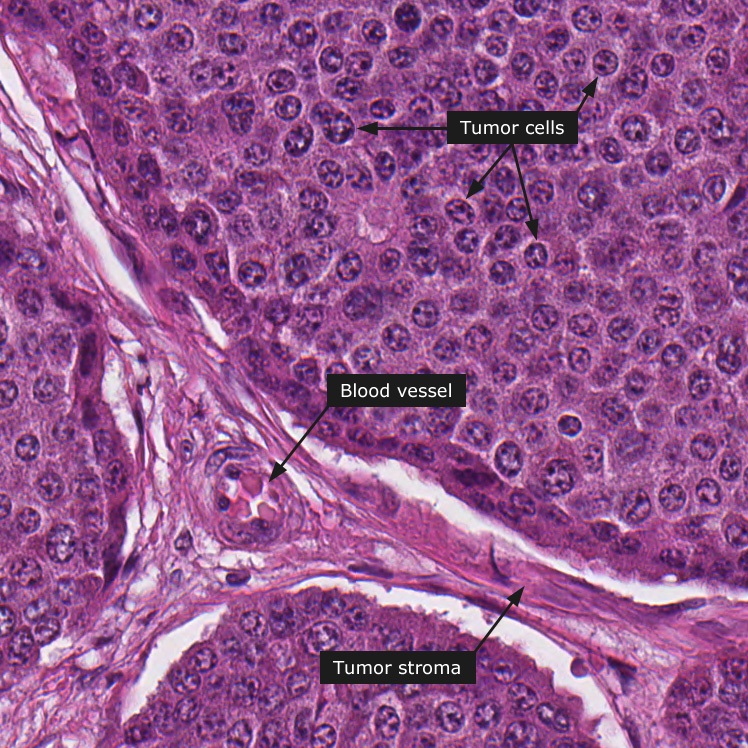 Facts About Neuroendocrine Tumor Cancer​