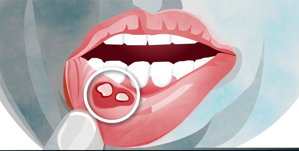 What is canker sores?
