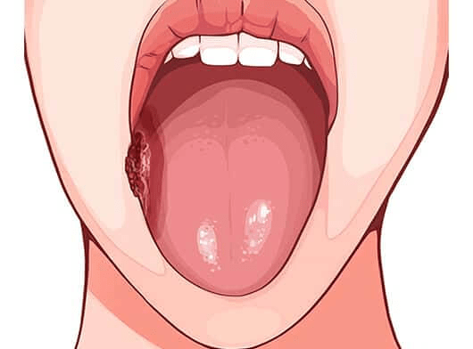 Mouth Ulcers